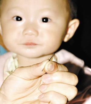女嬰胸部發現32mm縫衣針