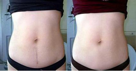 長了妊娠紋怎么辦 美姿秀給出正確的選擇