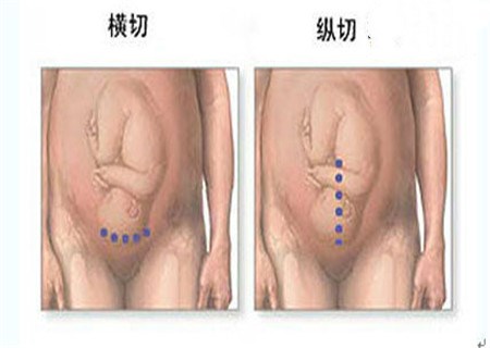 剖腹產(chǎn)是橫切好還是豎切好 要美觀選橫切，要容易選豎切