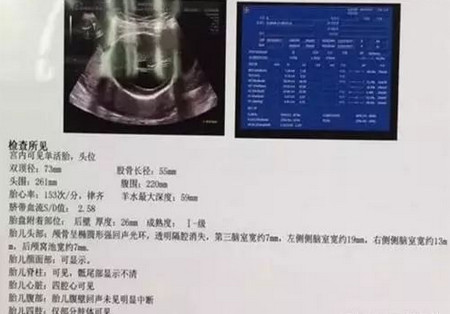 這個不幸的寶寶引產了，寶媽心很痛，但這個決定網友都表示支持！