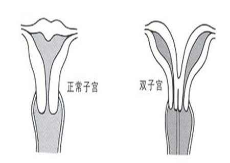 雙子宮切除后注意什么 各個方面要注意