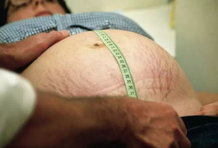 準媽媽該怎么預防妊娠紋？這個方法最有效！