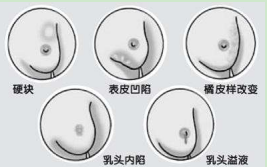 治療乳腺纖維瘤吃什么藥 乳腺纖維瘤禁吃什么