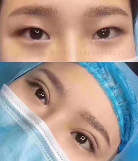 青島割雙眼皮一般多少錢？