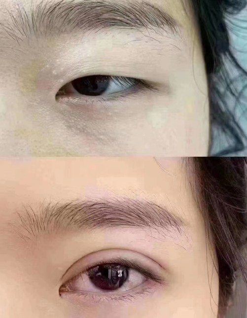 青島割雙眼皮最好的醫(yī)生