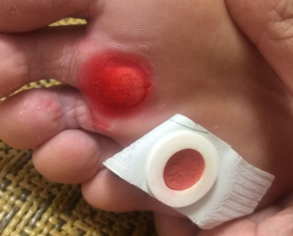 雞眼貼為什么越貼越痛